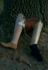 Prosthetic Stasis